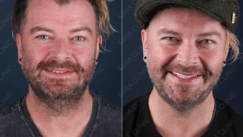 Veneers Before and After